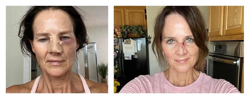 Kathy Sabine following her July 8 surgery and in a selfie taken on July 18.