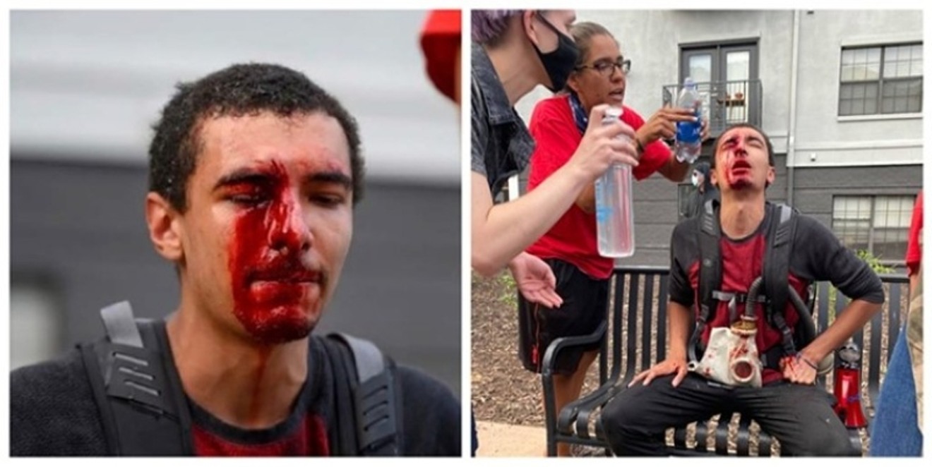 Two images of injuries to student Michael Acker during the 2020 George Floyd protests shared in a lawsuit settled in January for $500,000.