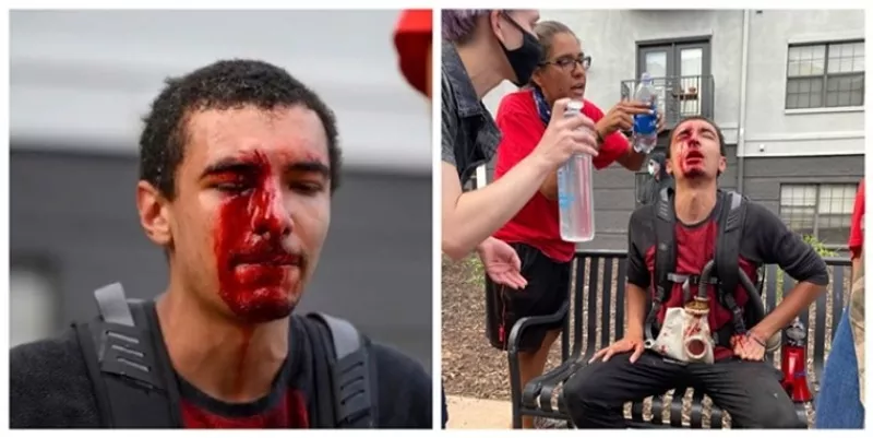 Image: Two images of injuries to student Michael Acker during the 2020 George Floyd protests shared in a lawsuit settled in January for $500,000.